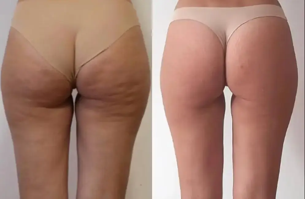 Sky Roller Lymphatic Treatment