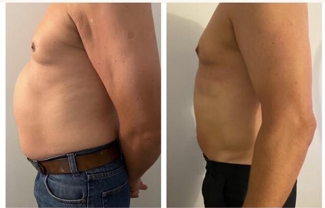 XR7 Muscle Stimulation